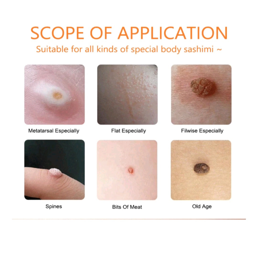 Aichun Beauty Anti Wart Cream