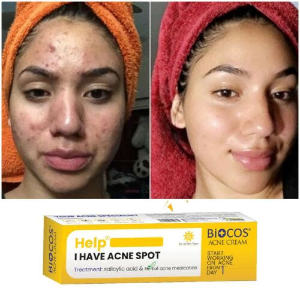 Biocos Acne Cream
